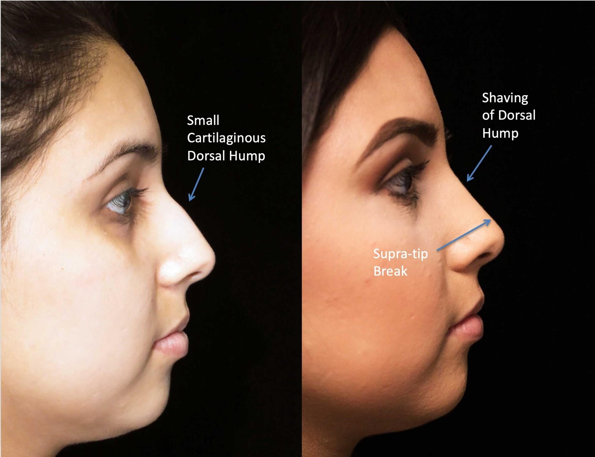 rhinoplasty surgery