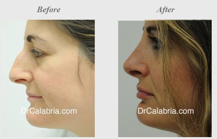 rhinoplasty surgery near me