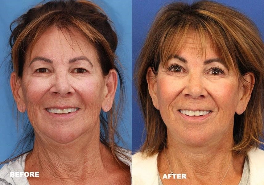 rhinoplasty surgery